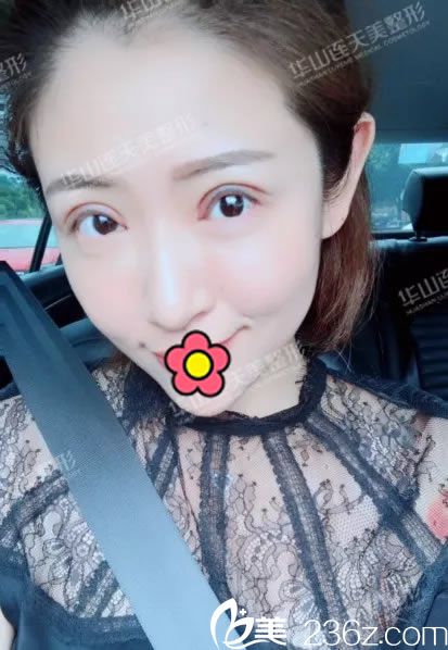 連天美盛飛雙眼皮修復(fù)案例7天效果 連天美盛飛雙眼皮修復(fù)案例7天效果
