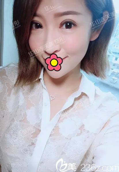 打盛飛做華派重瞼修復(fù)15天恢復(fù)圖 打盛飛做華派重瞼修復(fù)15天恢復(fù)圖