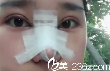 太原華美雙眼皮+鼻綜合手術(shù)后第3天照片