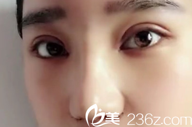 太原華美<!--<i data=20240703-sp></i>-->鼻綜合+雙眼皮術(shù)后第7天照片