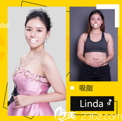 深圳鵬愛秀琪醫(yī)療美容醫(yī)院薛林兵全身吸脂案例 深圳鵬愛秀琪醫(yī)療美容醫(yī)院薛林兵全身吸脂案例