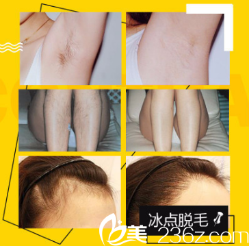 深圳鵬愛秀琪醫(yī)療美容醫(yī)院冰點脫毛案例 深圳鵬愛秀琪醫(yī)療美容醫(yī)院冰點脫毛案例