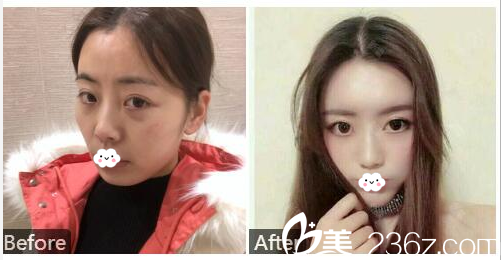 深圳鵬愛秀琪醫(yī)療美容醫(yī)院石東文自體脂肪面部全臉填充案例 深圳鵬愛秀琪醫(yī)療美容醫(yī)院石東文自體脂肪面部全臉填充案例