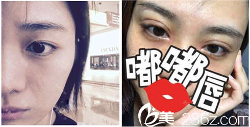 深圳麗港麗格石東文雙眼皮效果圖