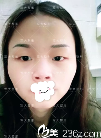 全切雙眼皮+膨體隆鼻術(shù)前照 全切雙眼皮+膨體隆鼻術(shù)前照