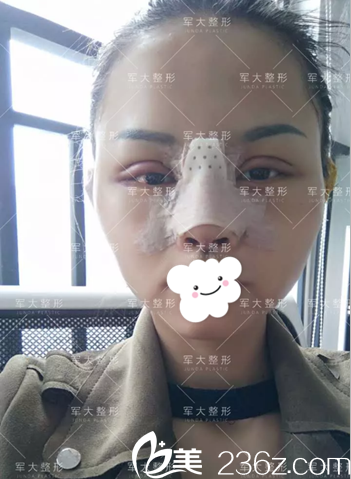 <i data-id='2257c2bc-36a4-4e95-bc55-f7ec9c660362' style='display:none;'></i>全切雙眼皮術(shù)后3天 <i data-id='2257c2bc-36a4-4e95-bc55-f7ec9c660362' style='display:none;'></i>全切雙眼皮術(shù)后3天