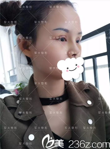 <i data-id='2257c2bc-36a4-4e95-bc55-f7ec9c660362' style='display:none;'></i>膨體隆鼻術(shù)后5天拆線 <i data-id='2257c2bc-36a4-4e95-bc55-f7ec9c660362' style='display:none;'></i>膨體隆鼻術(shù)后5天拆線