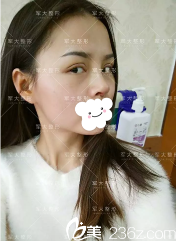 全切雙眼皮+膨體隆鼻術(shù)后10天 全切雙眼皮+膨體隆鼻術(shù)后10天