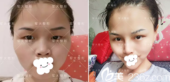 <i data-id='2257c2bc-36a4-4e95-bc55-f7ec9c660362' style='display:none;'></i>全切雙眼皮+膨體隆鼻術(shù)前術(shù)后對(duì)比 <i data-id='2257c2bc-36a4-4e95-bc55-f7ec9c660362' style='display:none;'></i>全切雙眼皮+膨體隆鼻術(shù)前術(shù)后對(duì)比