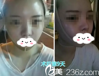 術(shù)后九天 術(shù)后九天