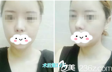 手術(shù)第十天 手術(shù)第十天