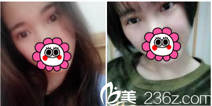 術后23天的樣子