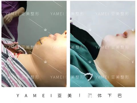 金華亞美胡華兵院長假體下巴<span style=