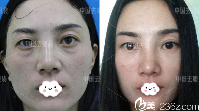 廣州美詩沁醫(yī)療美容醫(yī)院祛眼袋怎么樣？看霍建法醫(yī)生案例