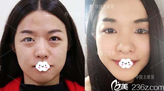 廣州美詩沁醫(yī)療美容醫(yī)院張永義院長祛眼袋案例