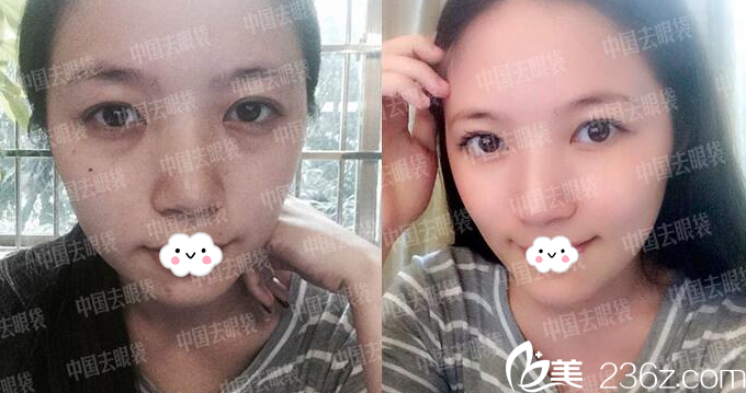 廣州美詩沁醫(yī)療美容醫(yī)院馬滿倉院長祛眼袋案例