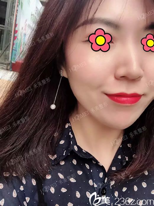 注射玻尿酸豐下巴的即刻效果圖