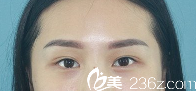 <!--<i data=20240703-sp></i>-->雙眼皮修復(fù)術(shù)前照 <!--<i data=20240703-sp></i>-->雙眼皮修復(fù)術(shù)前照