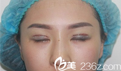 <!--<i data=20240703-sp></i>-->楊明峰雙眼皮失敗修復(fù)術(shù)后當(dāng)天照片 <!--<i data=20240703-sp></i>-->楊明峰雙眼皮失敗修復(fù)術(shù)后當(dāng)天照片