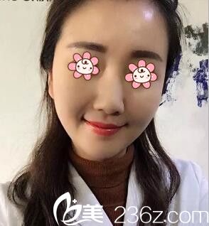 我承認(rèn)新疆華美整形醫(yī)院王世宏做的自體脂肪豐太陽(yáng)穴+豐臉頰+豐額頭真不含糊