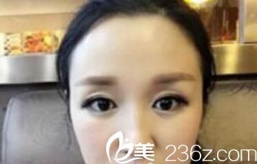 我在洛陽孔繁榮整形做了眼綜合因?yàn)閱渭冸p眼皮手術(shù)都不能拯救我的眼睛 