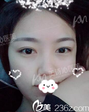 在廣州美詩沁去眼袋11天自拍