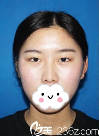 眼鼻整形術(shù)前樣子 眼鼻整形術(shù)前樣子