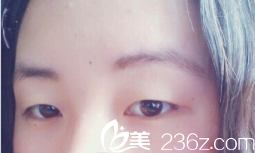 術(shù)前照 術(shù)前照