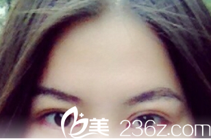 術(shù)后1個(gè)月的樣子 術(shù)后1個(gè)月的樣子