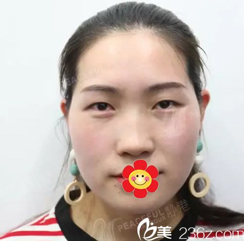 我在靜港做雙眼皮手術(shù)前的照片 我在靜港做雙眼皮手術(shù)前的照片