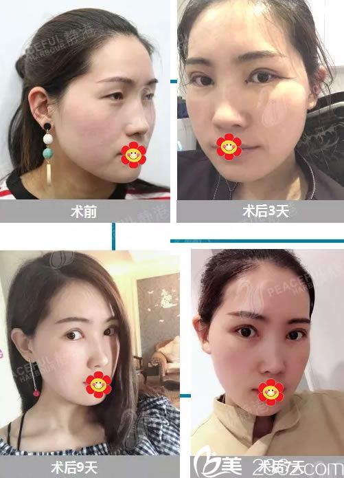 選擇寧波靜港林忠泵做雙眼皮恢復(fù)過(guò)程 選擇寧波靜港林忠泵做雙眼皮恢復(fù)過(guò)程