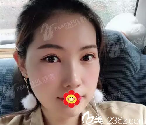 不知道靜港林忠泵割雙眼皮技術(shù)怎么樣的親 參考我在寧波靜港分院做的雙眼皮效果吧