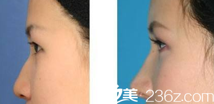 運(yùn)城麗都楊順新醫(yī)生隆鼻案例對(duì)比圖