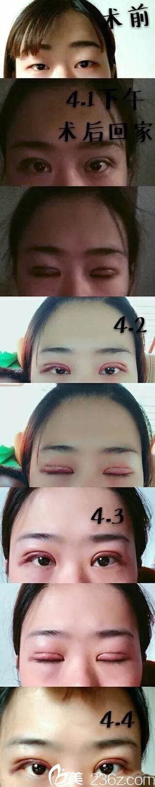 贛州韓美雙眼皮手術(shù)案例 贛州韓美雙眼皮手術(shù)案例