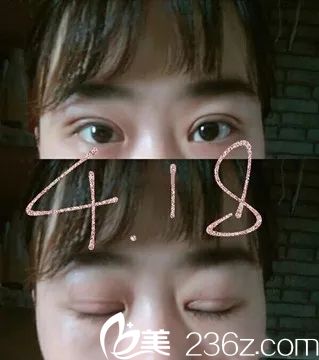 贛州韓美雙眼皮手術(shù)案例 贛州韓美雙眼皮手術(shù)案例