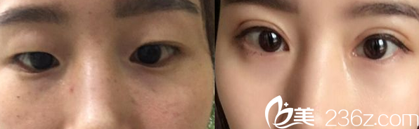 運(yùn)城麗都切開雙眼皮案例對(duì)比圖