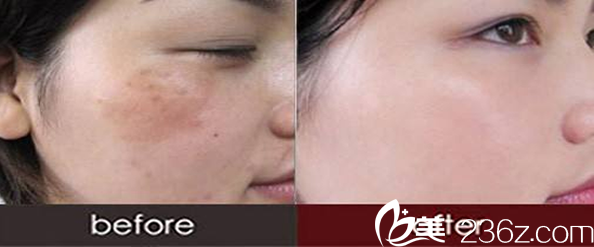 運(yùn)城麗都祛斑效果圖