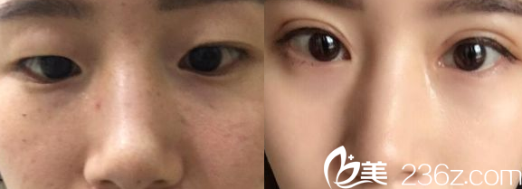 運(yùn)城華美<!--<i data=20240703-sp></i>-->醫(yī)生雙眼皮案例對比圖 運(yùn)城華美<!--<i data=20240703-sp></i>-->醫(yī)生雙眼皮案例對比圖