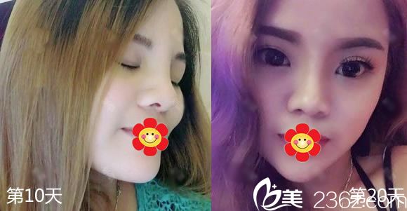 下決心在永康光大整形醫(yī)院蔣建光院長(zhǎng)這里做了韓士生科硅膠假體隆鼻