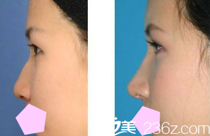 運城華美王惠民注射隆鼻案例對比圖 運城華美王惠民注射隆鼻案例對比圖