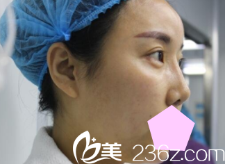 運城華美<!--<i data=20240703-sp></i>-->醫(yī)生鼻綜合術(shù)前照 運城華美<!--<i data=20240703-sp></i>-->醫(yī)生鼻綜合術(shù)前照