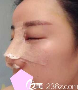 運城華美<!--<i data=20240703-sp></i>-->隆鼻失敗修復(fù)手術(shù)后第3天照片 運城華美<!--<i data=20240703-sp></i>-->隆鼻失敗修復(fù)手術(shù)后第3天照片