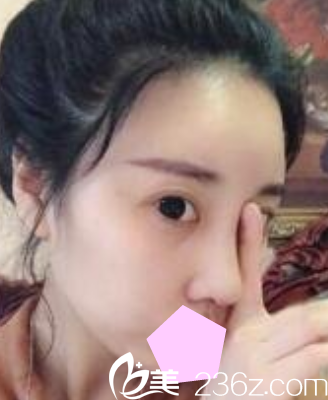 看了我找運城華美整形做的隆鼻失敗修復(fù)效果，就知道做鼻綜合怎么樣了?
