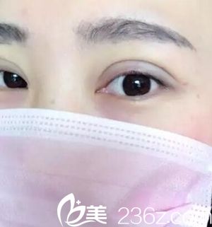沈陽名流做雙眼皮術(shù)后 沈陽名流做雙眼皮術(shù)后