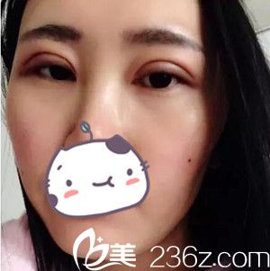 沈陽名流做雙眼皮術(shù)后第2天 沈陽名流做雙眼皮術(shù)后第2天