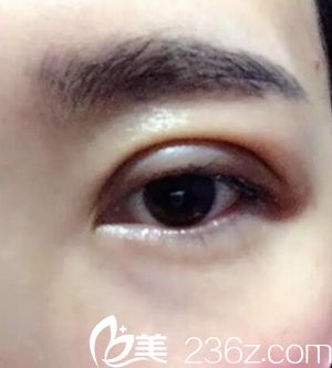 沈陽名流做雙眼皮術(shù)后效果 沈陽名流做雙眼皮術(shù)后效果