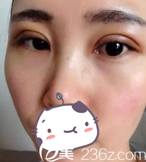 沈陽名流做雙眼皮術(shù)后第4天 沈陽名流做雙眼皮術(shù)后第4天