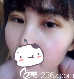 沈陽名流做雙眼皮術(shù)后第5天 沈陽名流做雙眼皮術(shù)后第5天