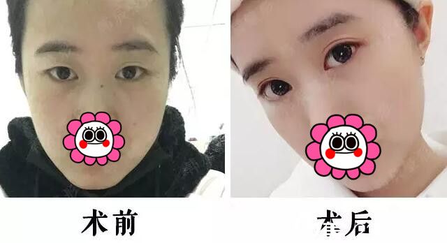 在南京韓辰做雙眼皮+開(kāi)眼角前后對(duì)比 在南京韓辰做雙眼皮+開(kāi)眼角前后對(duì)比