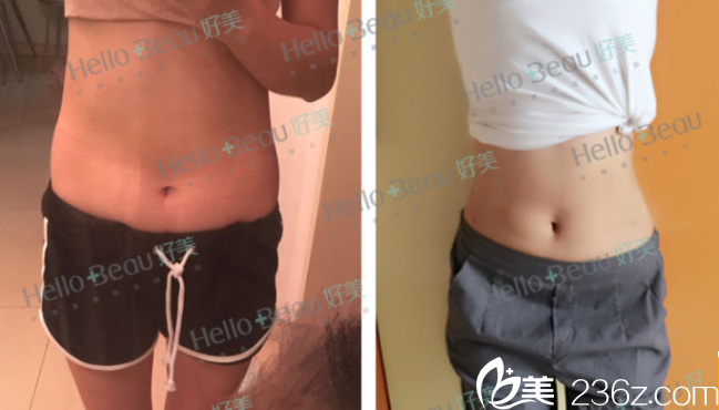 羅<!--<i data=20240703-sp></i>-->醫(yī)生腰腹部吸脂案例